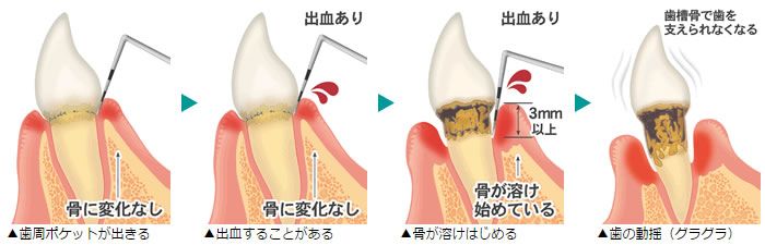 歯周病進行の様子